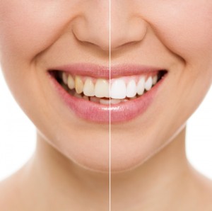 Whiten teeth at home with these DIY recipes! Via Shutterstock. 